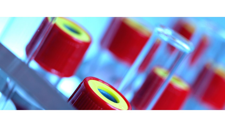 Talasemi Bu Belirtilerle Sinyal Veriyor 8 Mayis Dunya Talasemi Gunu Saglik Haberleri Ntv