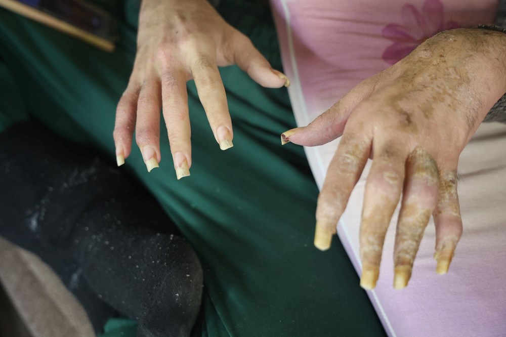 3 yıldır evden dışarı adım atmadı: "Banyo da yapmak istemiyorum, elimde olsa tuvalete gitmem" - 2