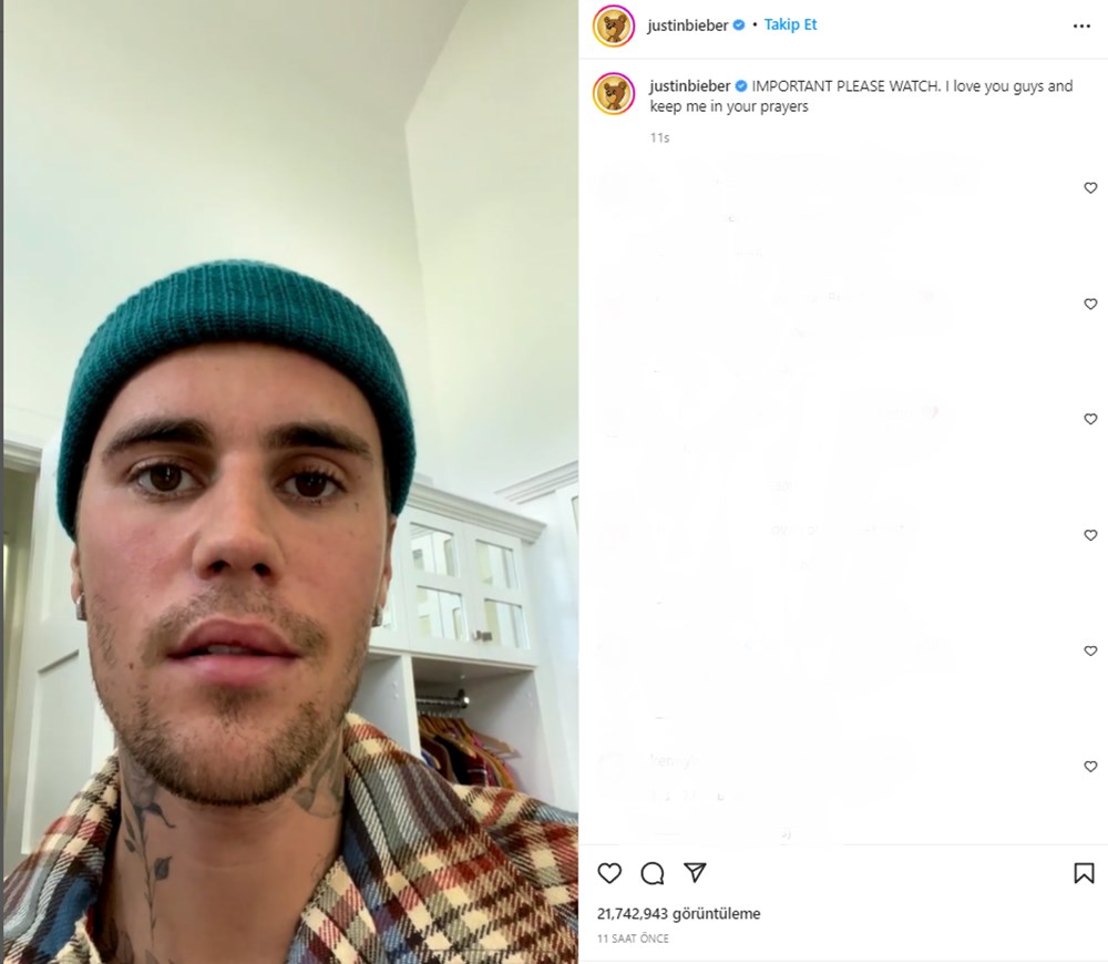 Justin Bieber nadir görülen bir sendrom nedeniyle yüz felci geçirdi - 2