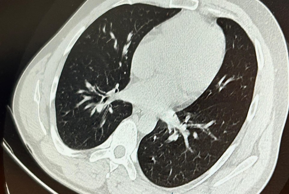 A patient narrowly escaped death after an implant screw got lodged in his lung - 1
