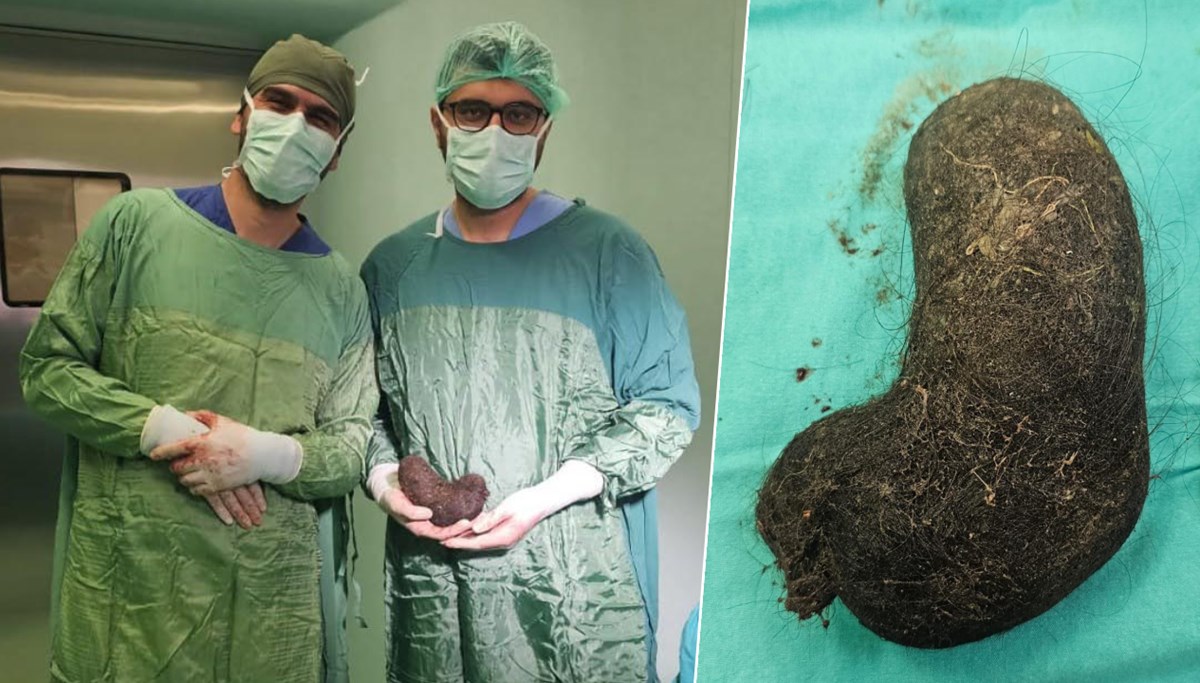 Midesinden çıkanlar doktorları şaşırttı Midesinden çıkanlar doktorları şaşırttı