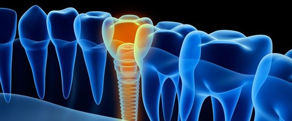 "Ucuz implantlar, bir süre sonra çene kemiğini eritir" (Uzman uyarısı)