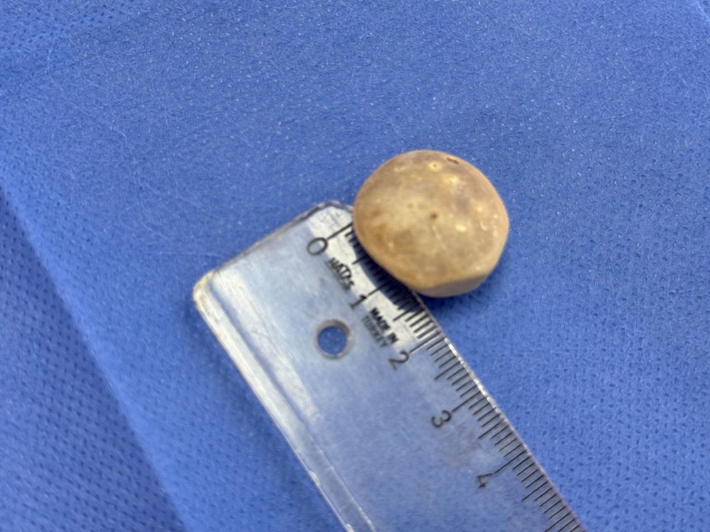 Doktorlar bile şaşırdı: Genç kızın vücudundan 287 adet taş çıkarıldı - 6