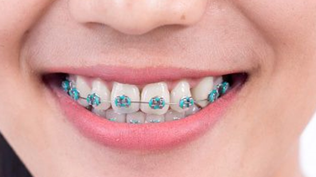 Dis Teli Tedavisinde Dogru Bilinen 7 Yanlis Saglik Haberleri Ntv