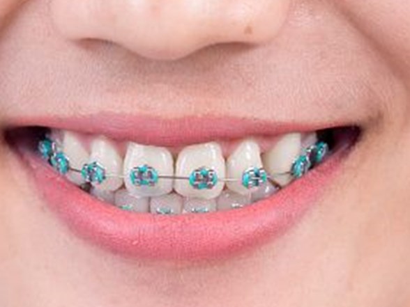 Dis Teli Tedavisinde Dogru Bilinen 7 Yanlis Saglik Haberleri Ntv