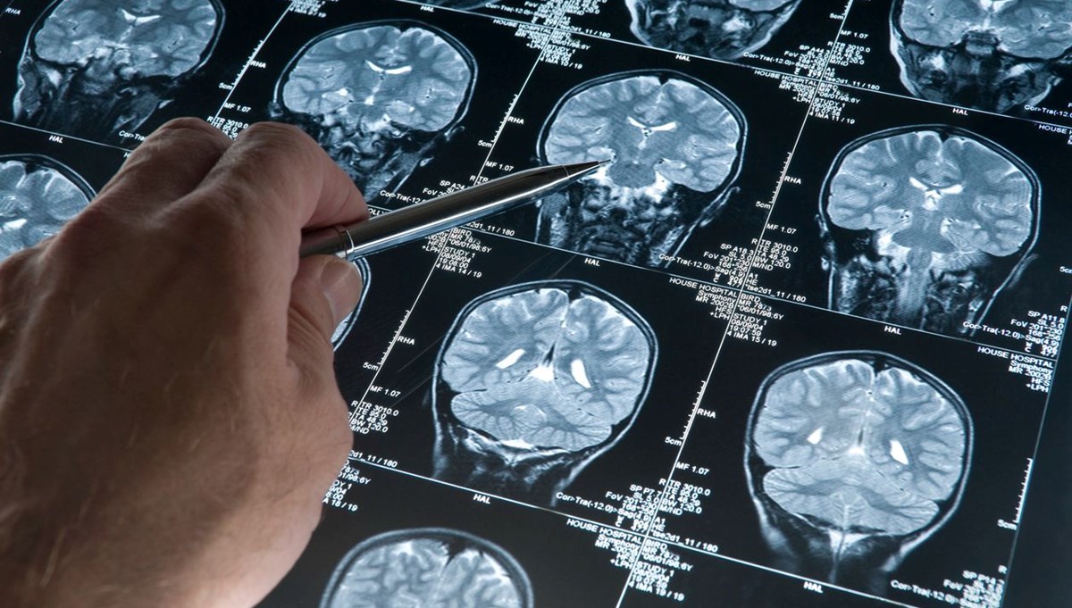 Alzheimer teşhisinde kan testi devrimi
