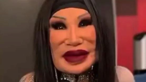 Ünlü oyuncunun son hali korkuttu: Yüzüne yemeklik yağ enjekte ettirmiş