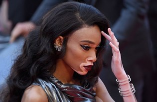 vitiligo nedir neden olusur vitiligo