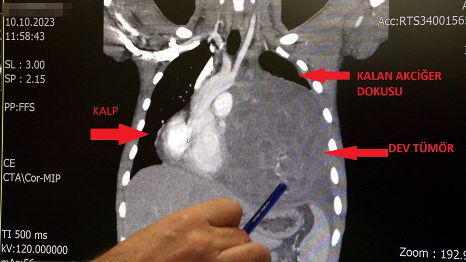 İstanbul'da doktorları bile şaşıran vaka! Kalbi 12 santim sağa kaydı - 2