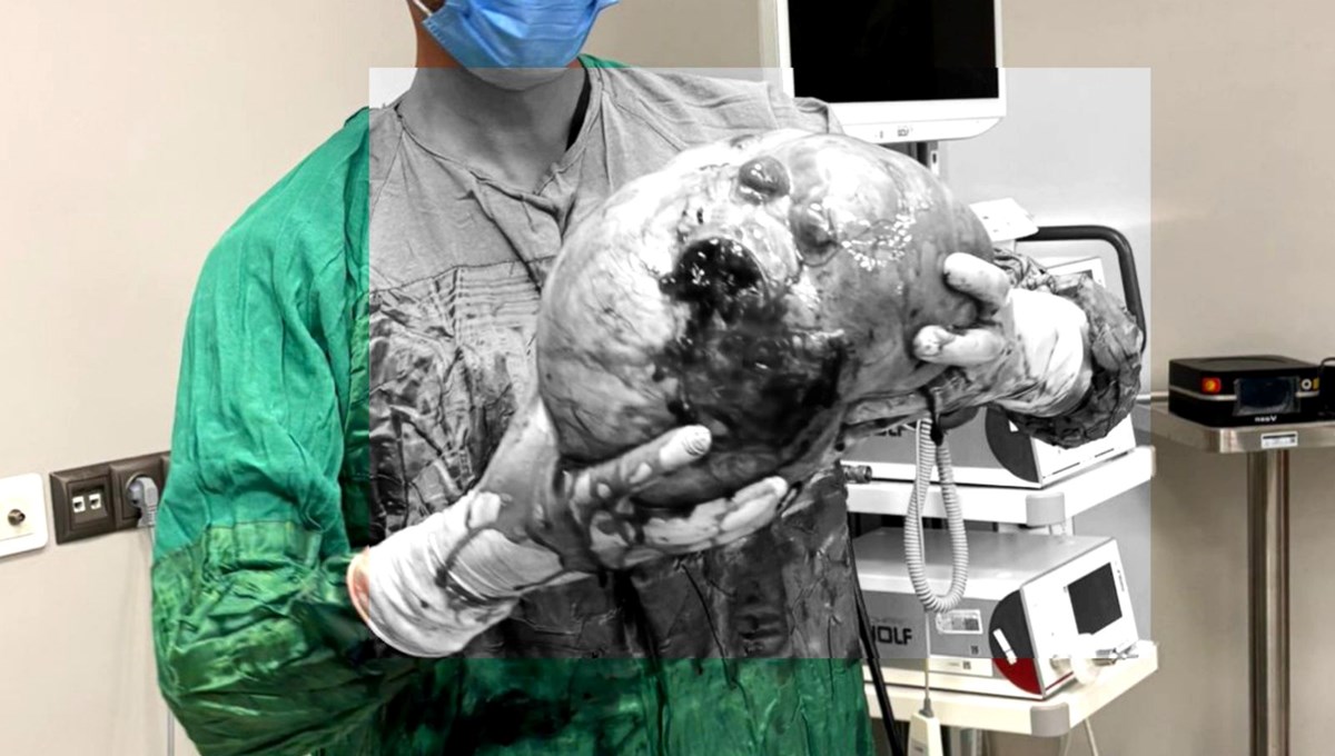 Karın ağrısıyla hastaneye gitti: 4 kilogram kitle varmış