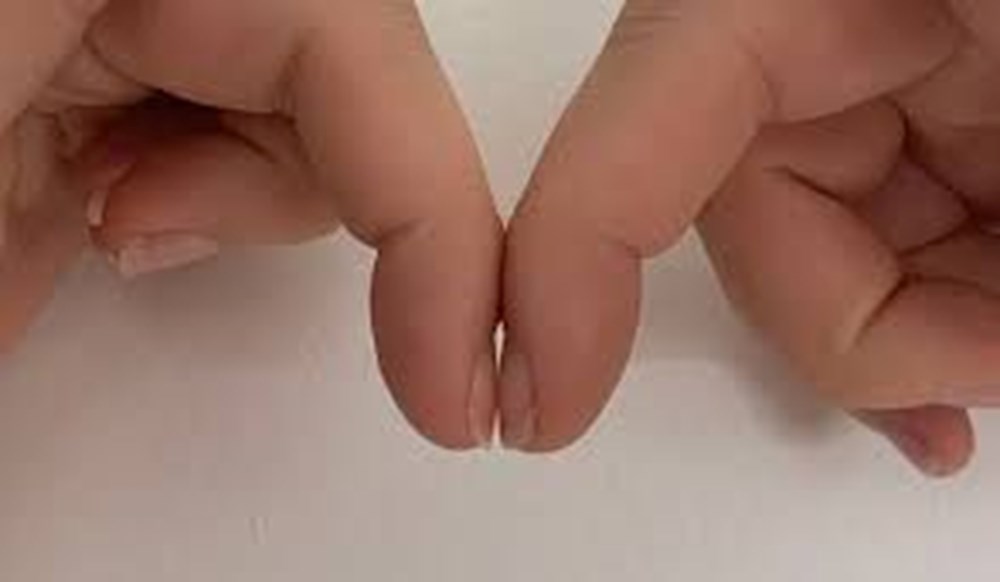 Akciğer kanseri riski için basit parmak testi: Schamroth Testi nasıl yapılır? - 5