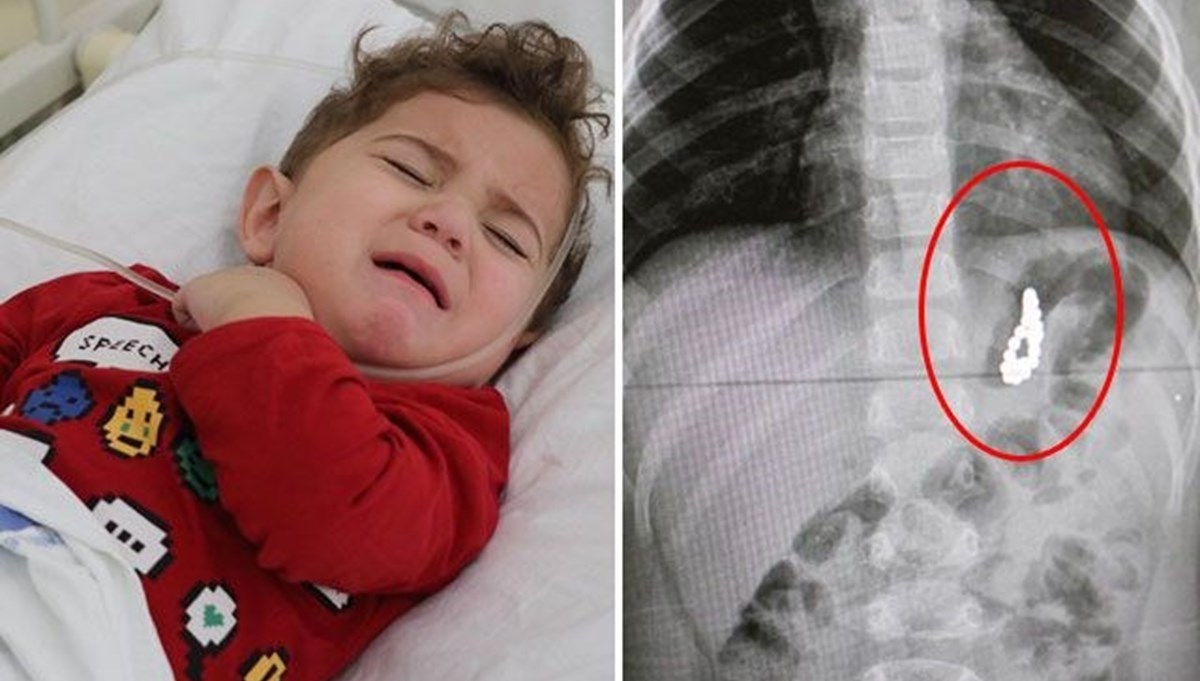 19 aylık Murat'ın midesinden 17 mıknatıs çıktı