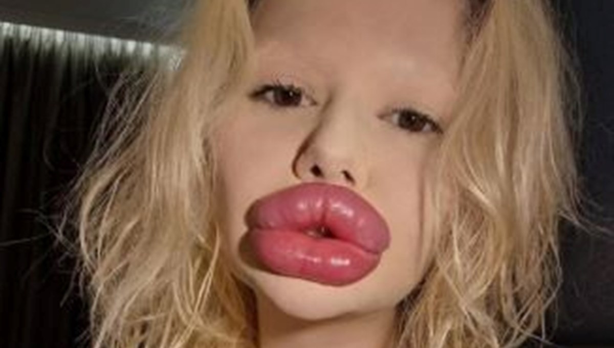 Dünyanın en büyük dudaklı kadını: Sağlık çalışanları onu tedavi etmeyi reddediyor