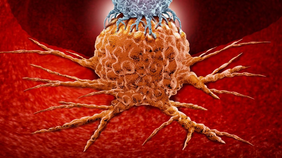 kolon kanseri nedir kalin bagirsak kanseri genclerde neden artiyor 5 soruda kolon kanseri