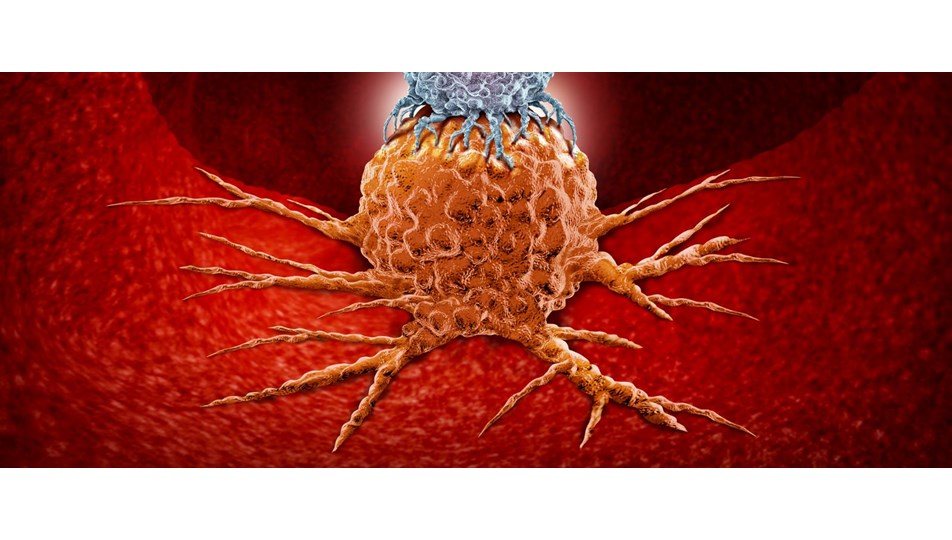 kolon kanseri nedir kalin bagirsak