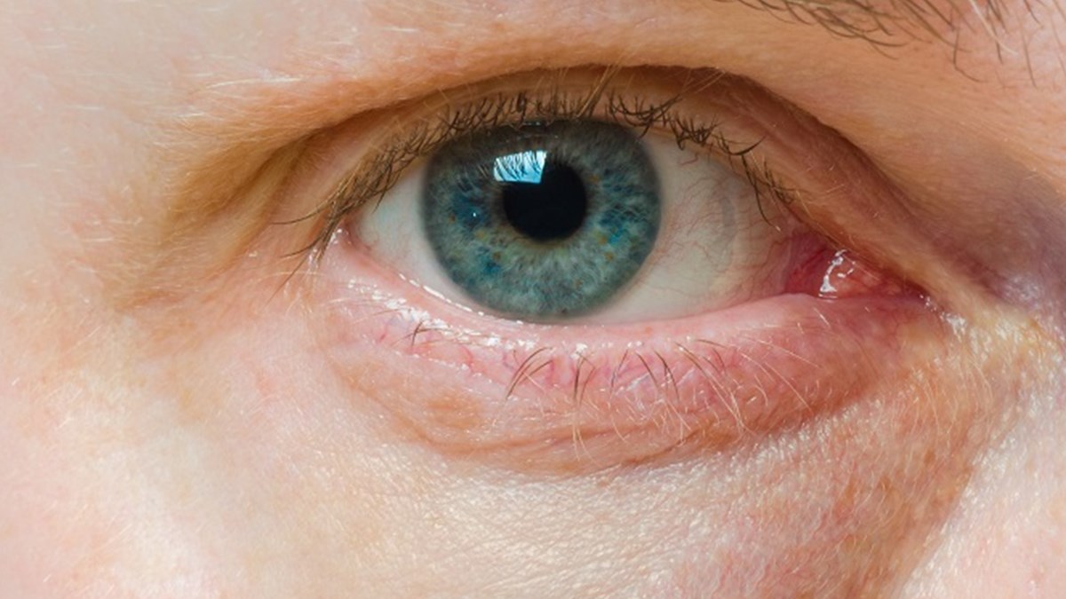 gozunde morluk var kenara cek saglik haberleri ntv