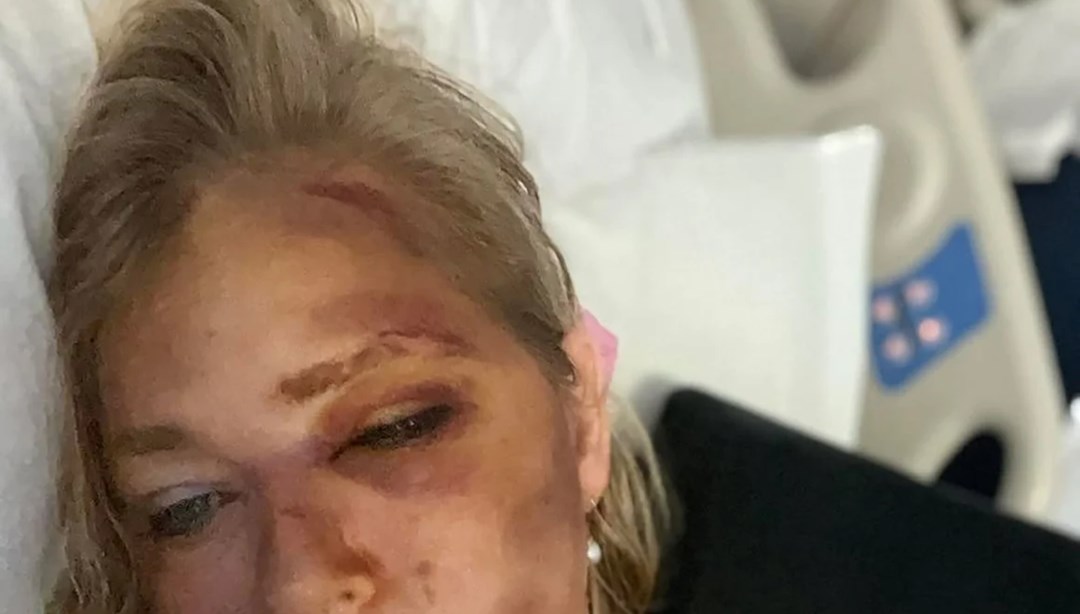 Pedofili milyarder Epstein kurbanı kadın kaza geçirdi!  "Sayılı günüm kaldı"