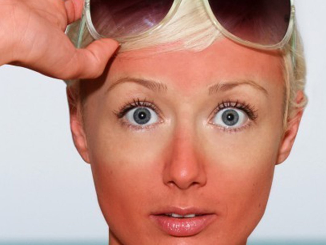 gunes yanigina yogurt ve dis macunu