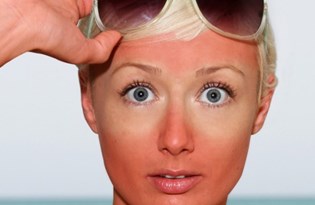 gunes yanigina ne iyi gelir gunes