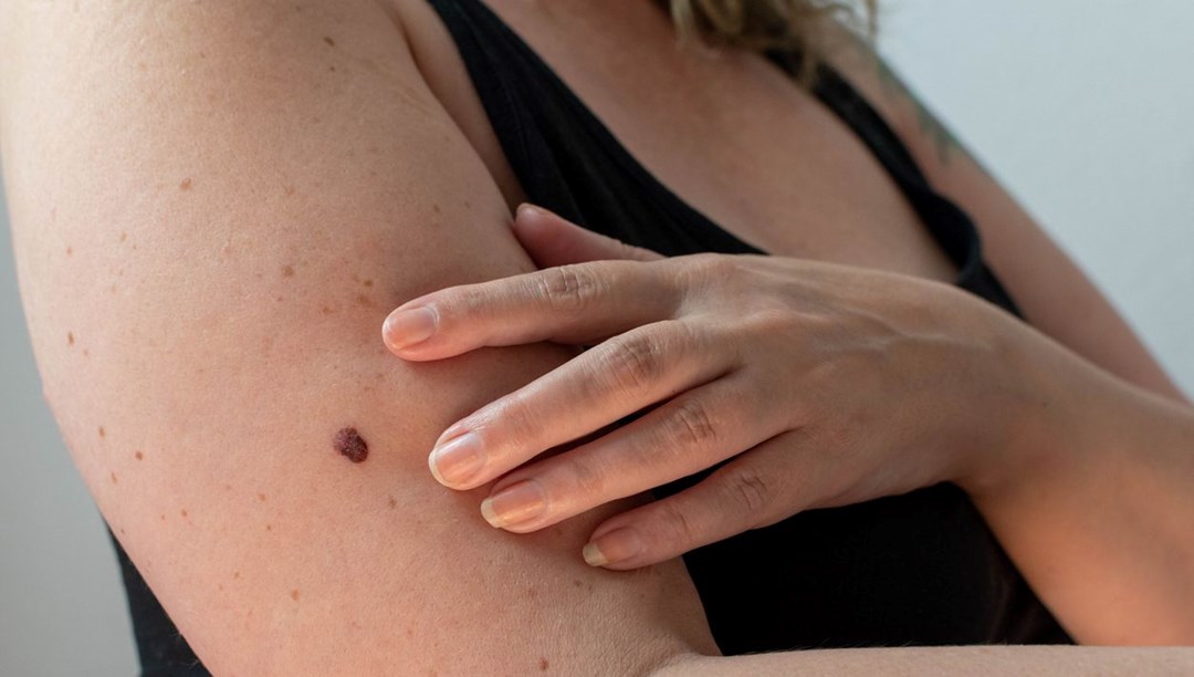 Gençlik yıllarında yaptığı hata yüzünden 15 yıldır kanserle savaşıyor