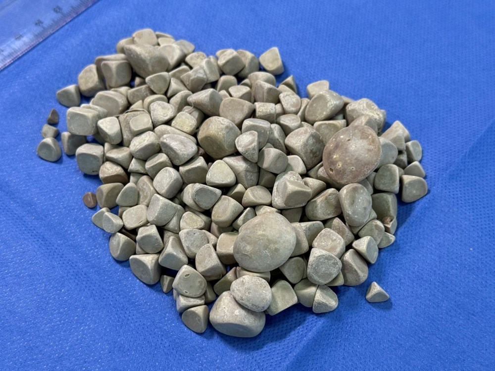 Doktorlar bile şaşırdı: Genç kızın vücudundan 287 adet taş çıkarıldı - 3