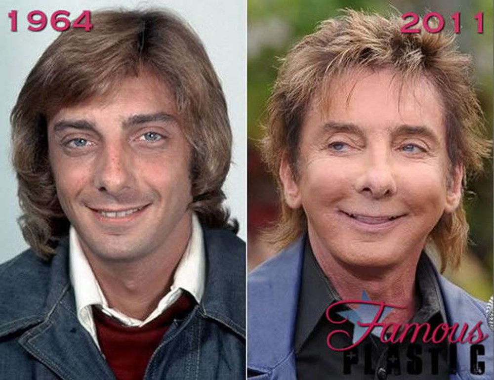 Барри манилов. Барри Манилоу фото в молодости и сейчас. Barry Manilow в молодости. Barry Manilow Plastic Surgery. Барри Манилоу пластика.