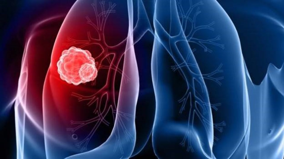 Akciğer kanseri yılda 50 bin kişiyi yakalıyor - 1