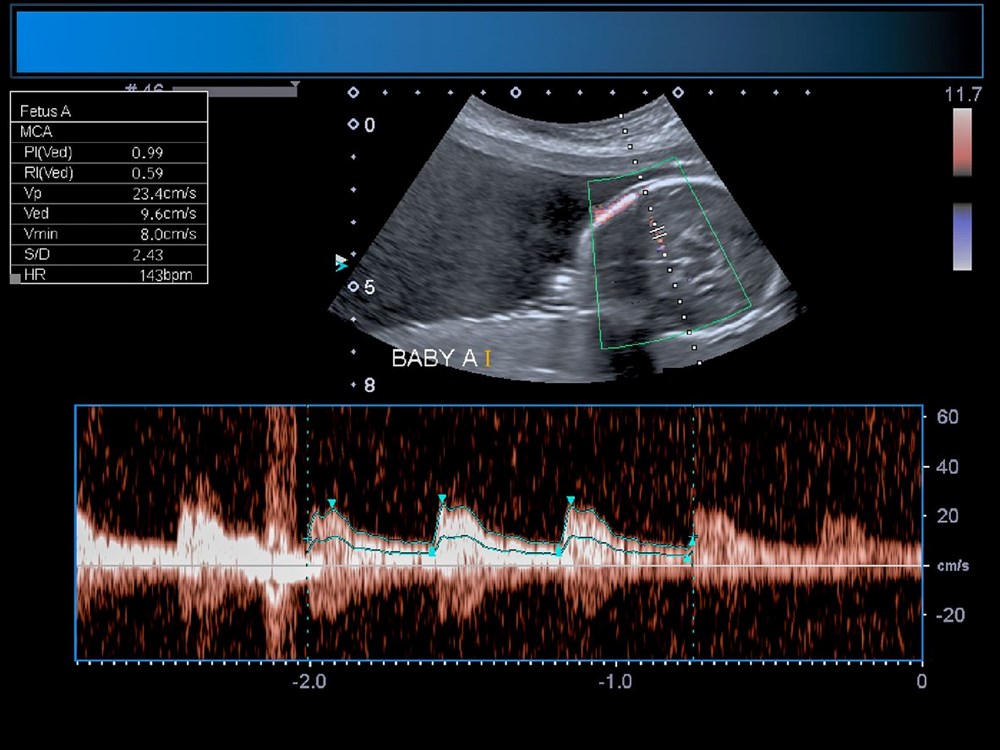 Dünyada ilk kez: Ölümcül genetik bozukluğu olan bebeğe rahimdeyken beyin ameliyatı yapıldı - 7