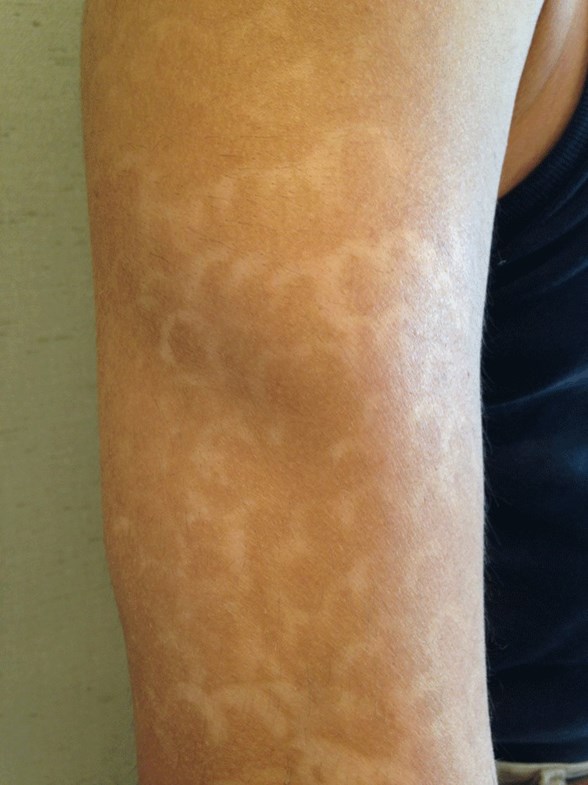 dermatologlardan lazer uyarisi saglik