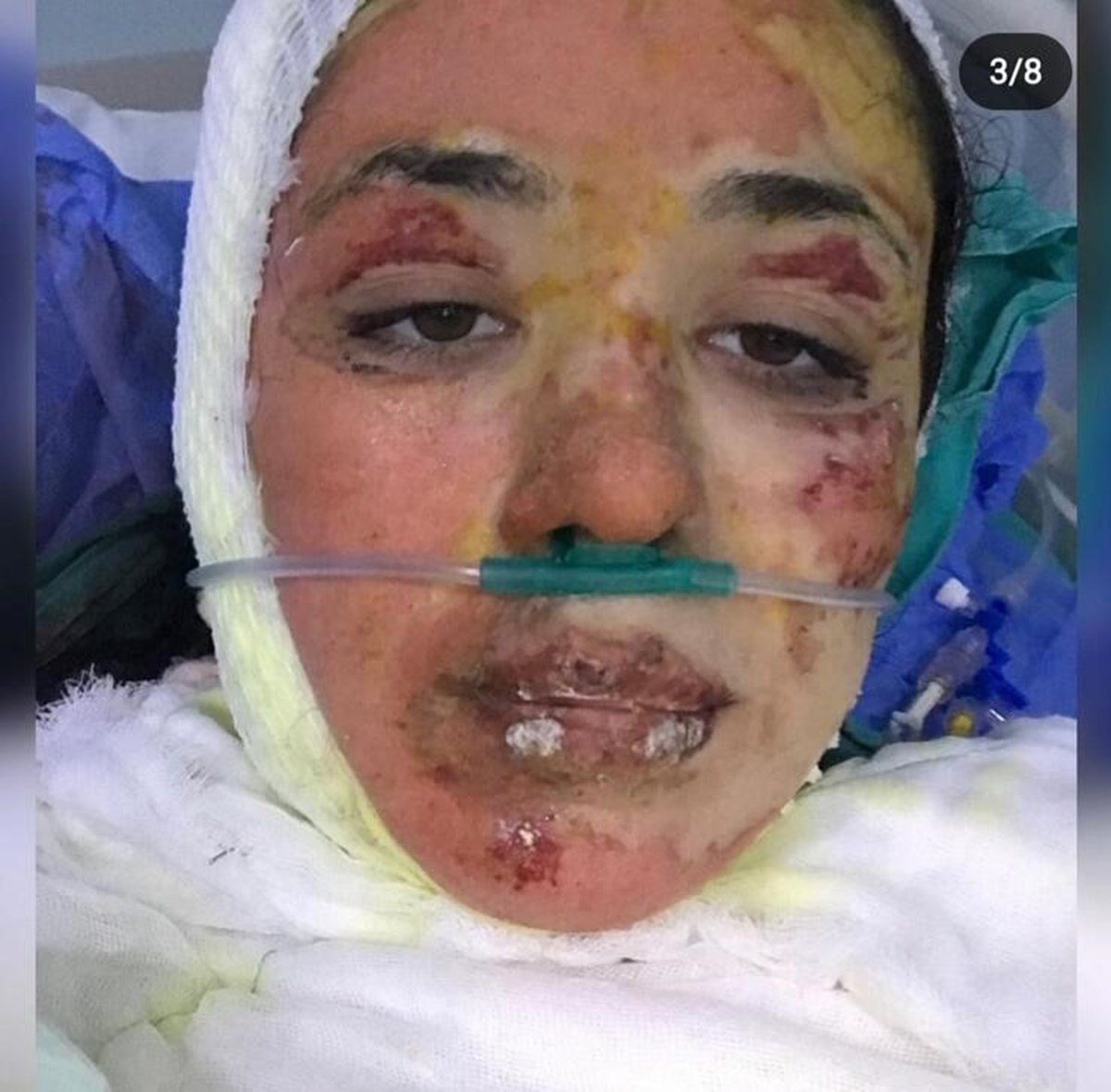 Vücudunda derin yanıklar oluşan Türk Vücudunda derin yanıklar oluşan Türk