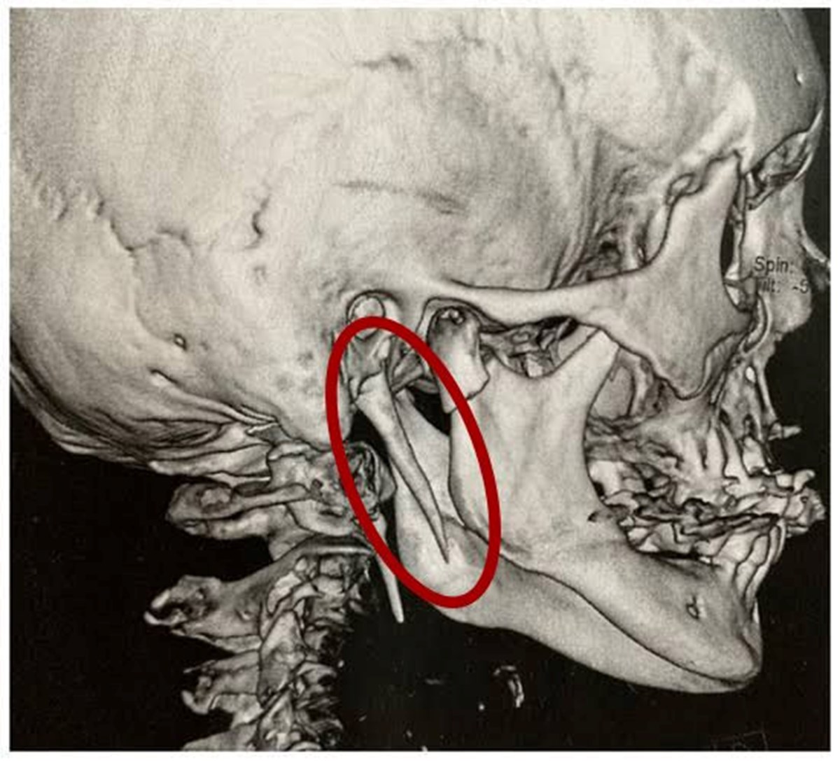 15 yıldır çektiği boyun ağrısının nedeni doktoru bile şaşırttı! Nadir görülen hastalıktan çığlık atası geliyordu