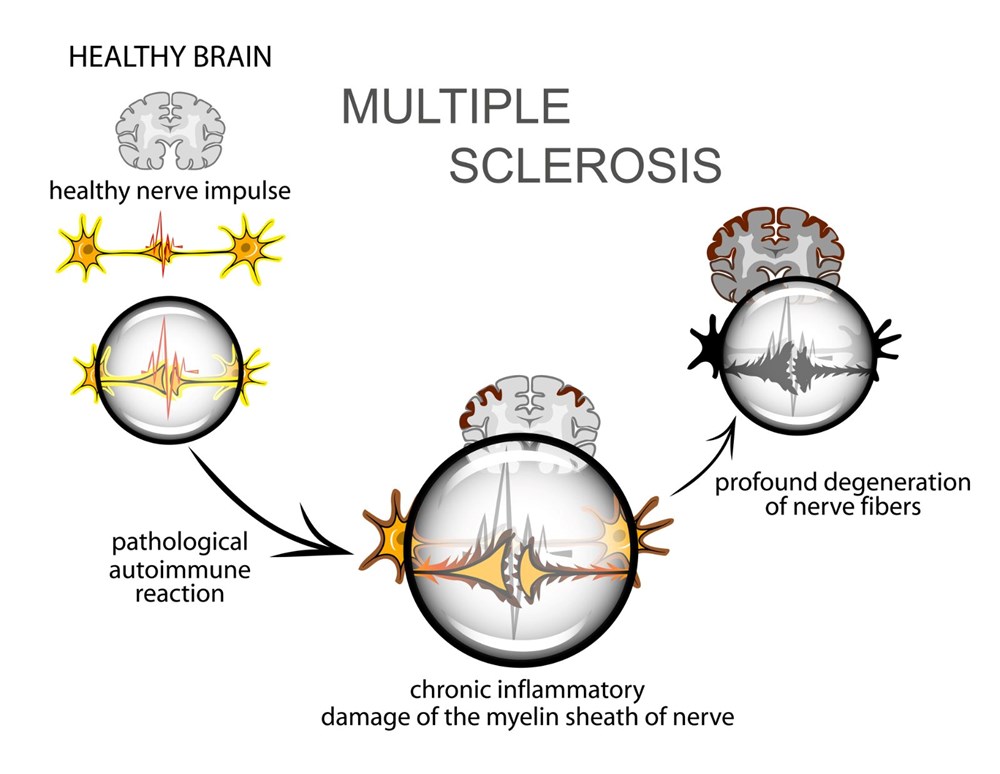 Multipl Skleroz'a (MS) karşı mRNA aşısı umudu - 5