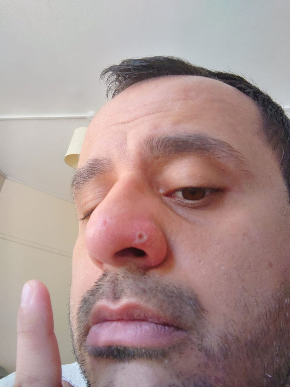 Dünyanın konuştuğu hasta: Önce HIV ve Covid sonra da maymun çiçeği - 8