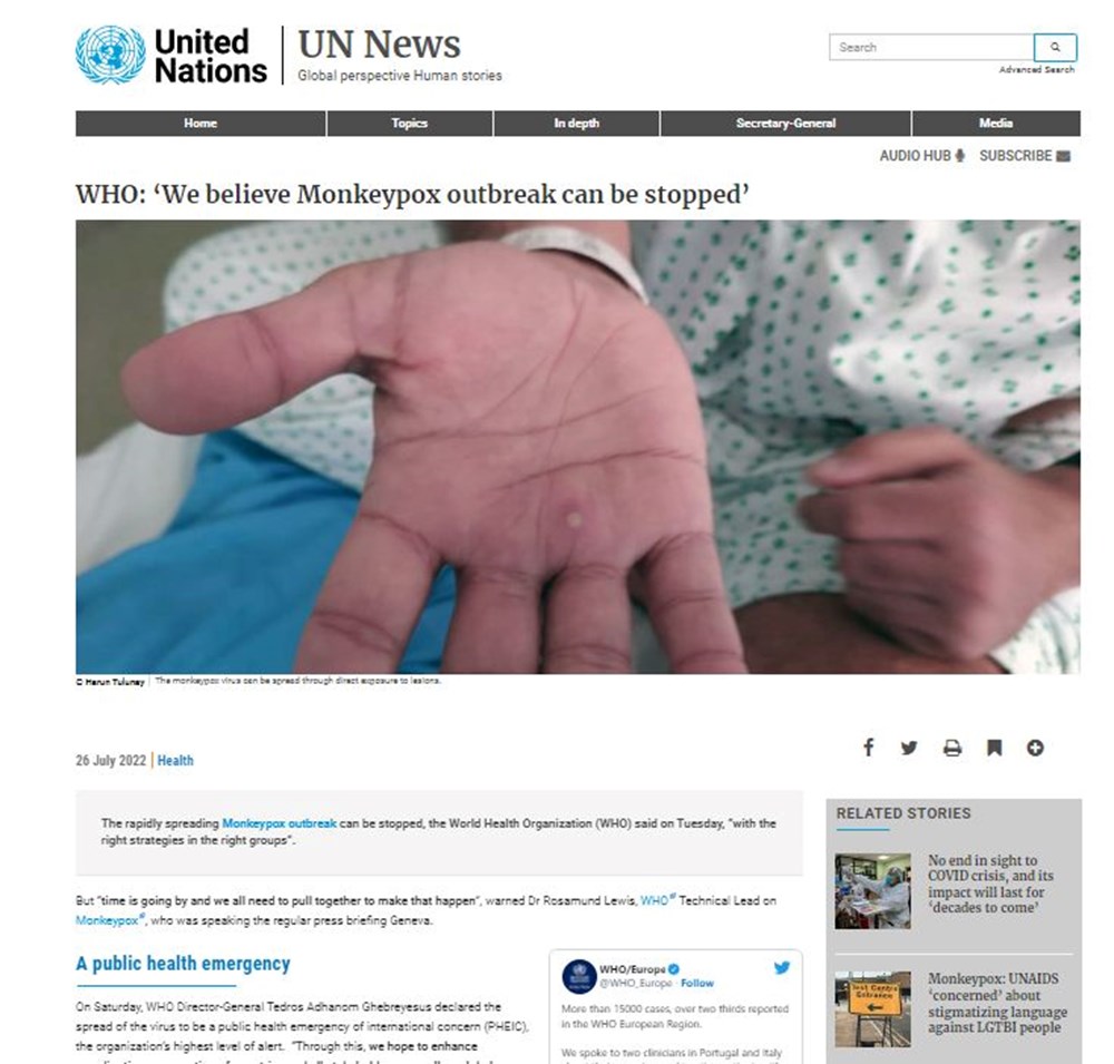 Dünyanın konuştuğu hasta: Önce HIV ve Covid sonra da maymun çiçeği - 5