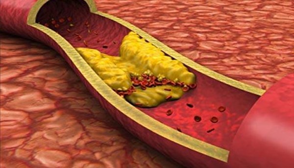 Kolesterol yüksekliği neden olur?.. İyi-kötü kolesterol nedir? (HDL-LDL nedir, iyi-kötü kolesterol farkı)