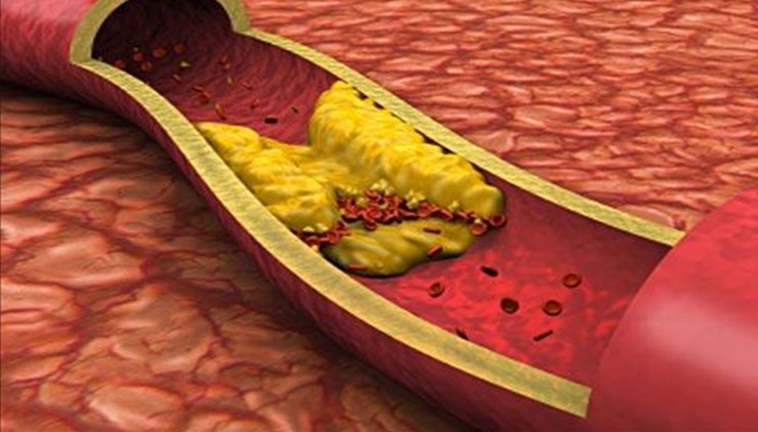 kolesterol yuksekligi neden olur iyi kotu kolesterol nedir hdl ldl nedir iyi kotu kolesterol farki saglik haberleri ntv