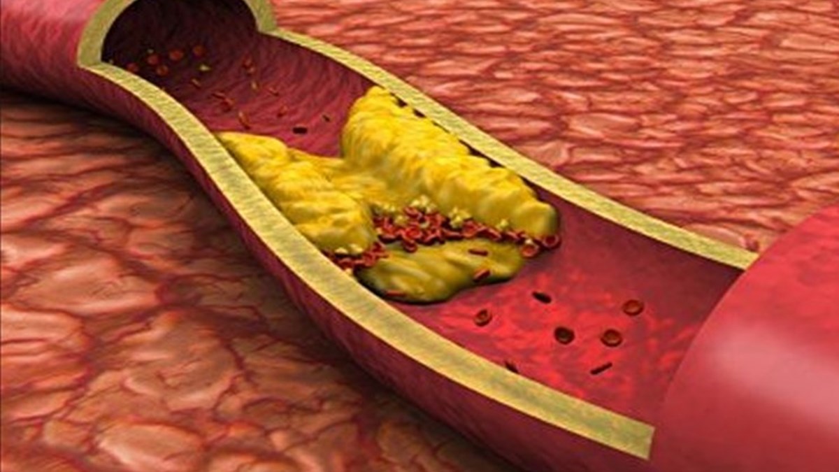kolesterol yuksekligi neden olur iyi kotu kolesterol nedir hdl ldl nedir iyi kotu kolesterol farki
