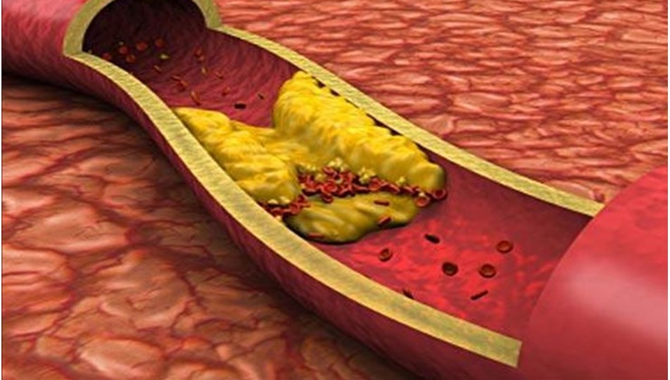 kolesterol yuksekligi neden olur iyi kotu kolesterol nedir hdl ldl nedir iyi kotu kolesterol farki