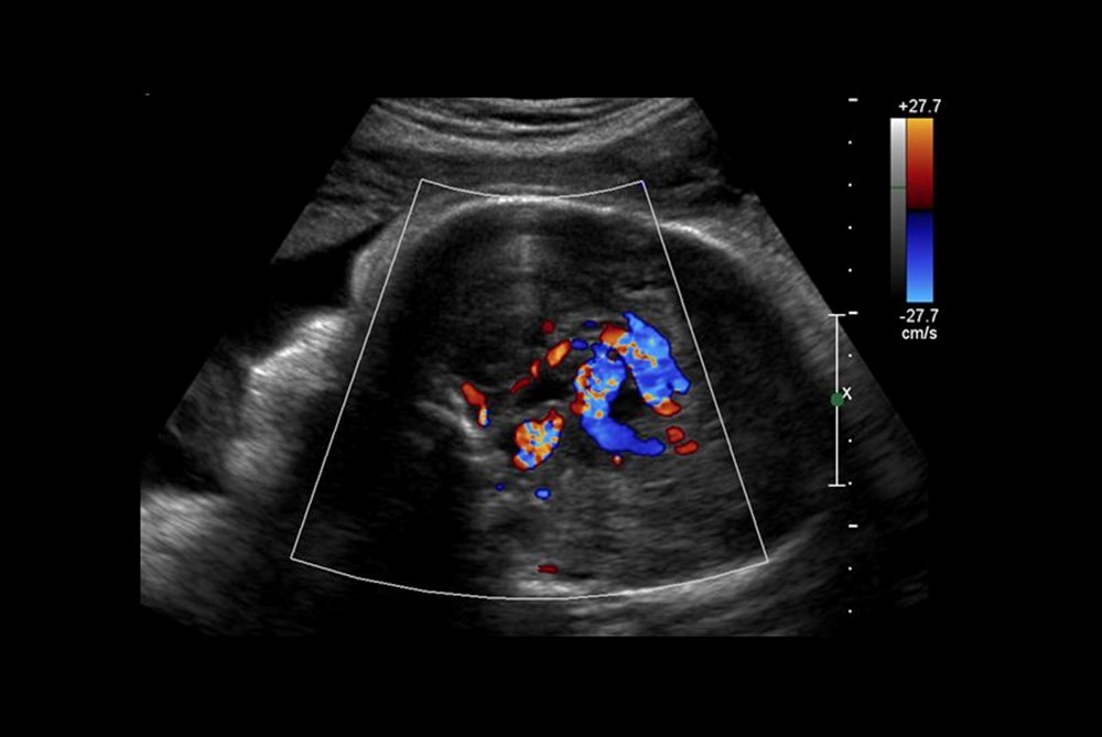 Dünyada ilk kez: Ölümcül genetik bozukluğu olan bebeğe rahimdeyken beyin ameliyatı yapıldı - 9