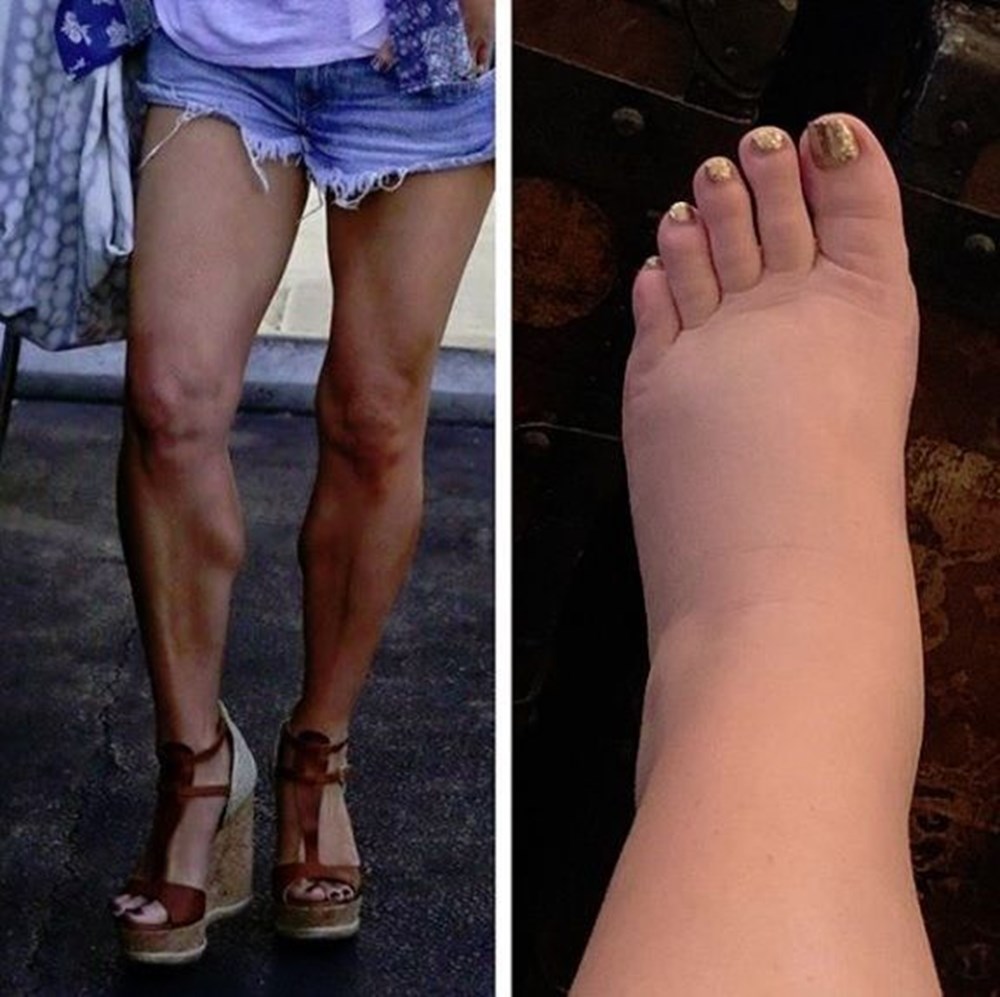 Усталость ног. Лимфостаз левой конечности. Сдулись ноги. Усталости ног, отечности,. Сдулись ноги.