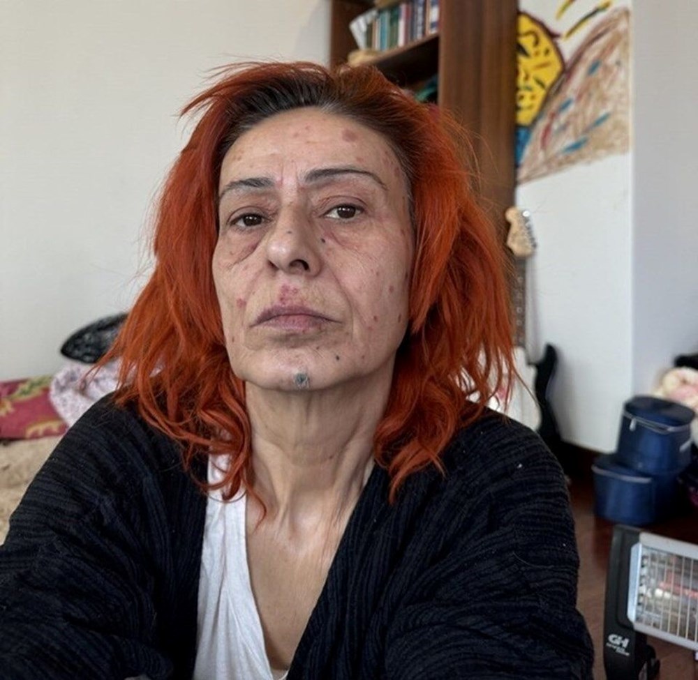 Yıldız Tilbe yüzündeki renkli beneklerle konser verdi - 1