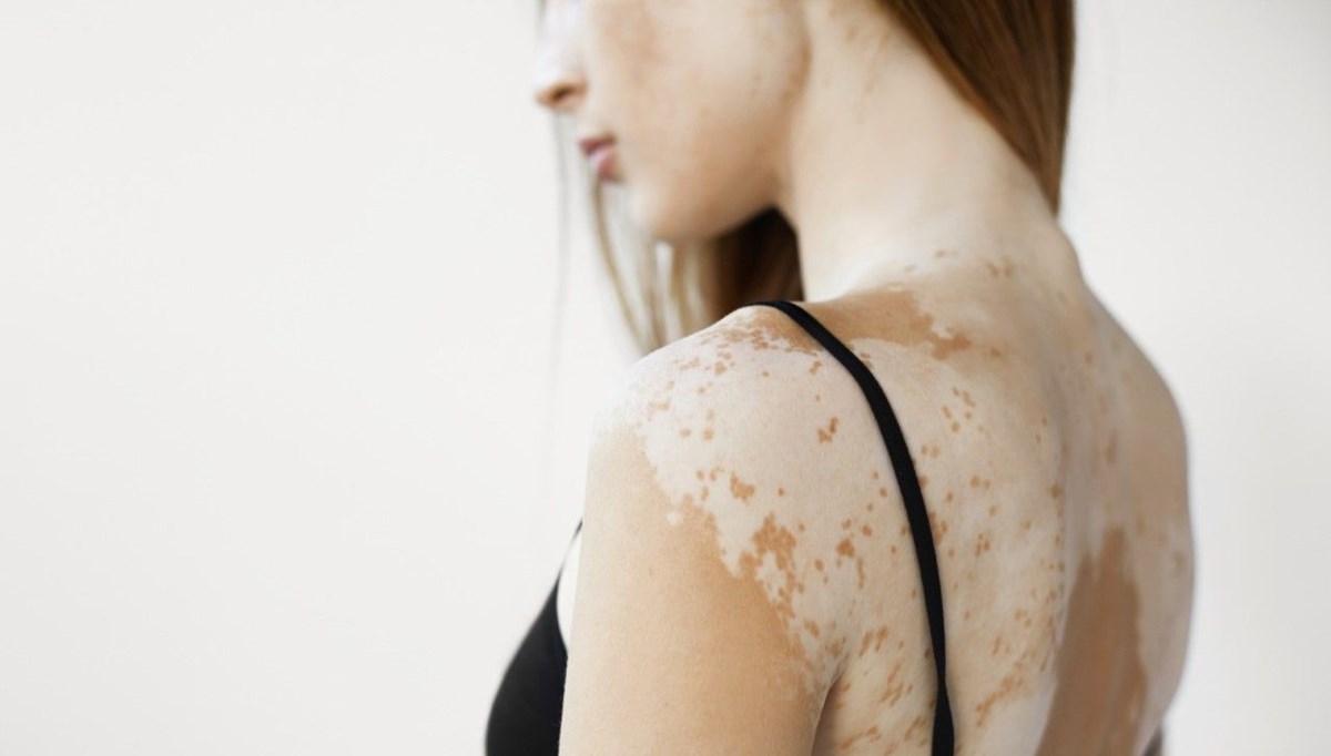 Vitiligo nedir, neden oluşur? (Vitiligo nasıl tedavi edilir?)