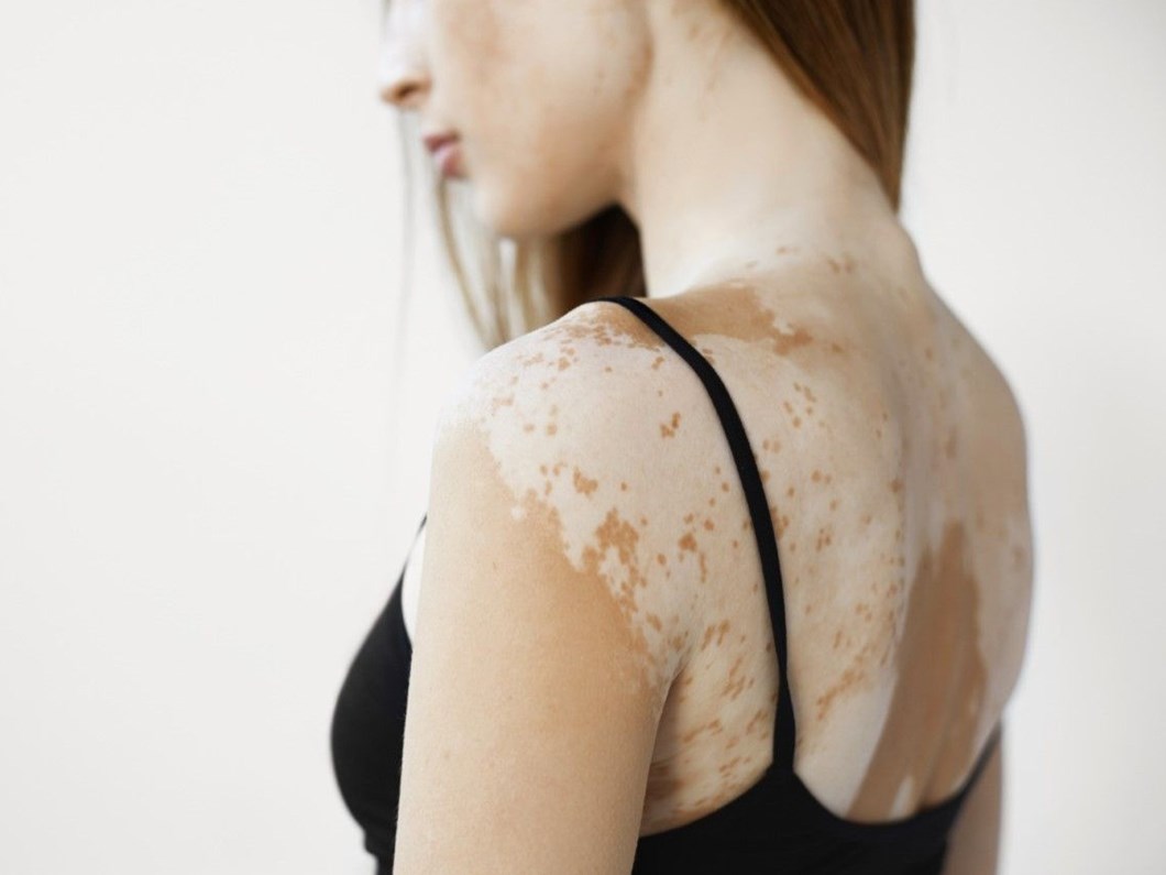 Vitiligo Hastaligi Nedir Bitkisel Tedavi Yontemleri Saglik Haberleri