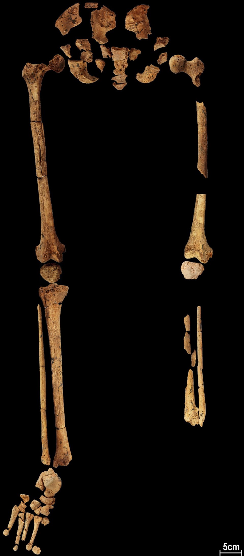 31 bin yıl öncesine ait iskelet, tarihin ilk amputasyonuna ışık tutuyor - 2