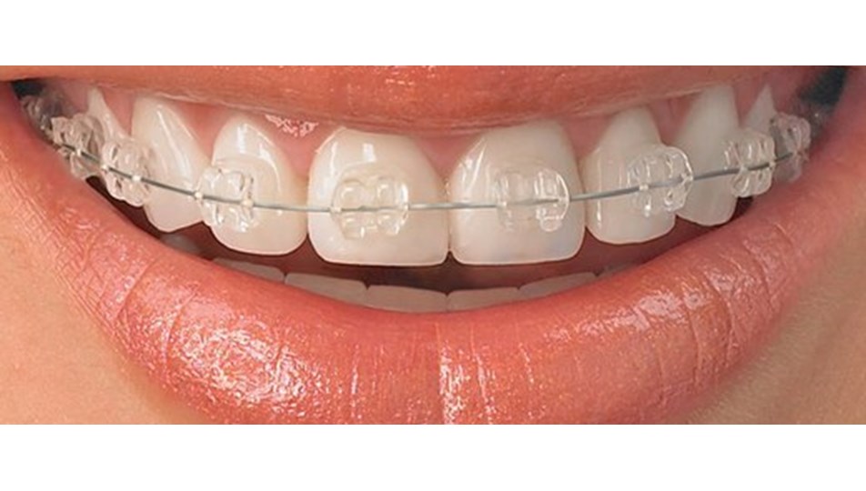 Ortodontik Tedavi Zamanlamasi Basariyi Etkiliyor Saglik Haberleri Ntv