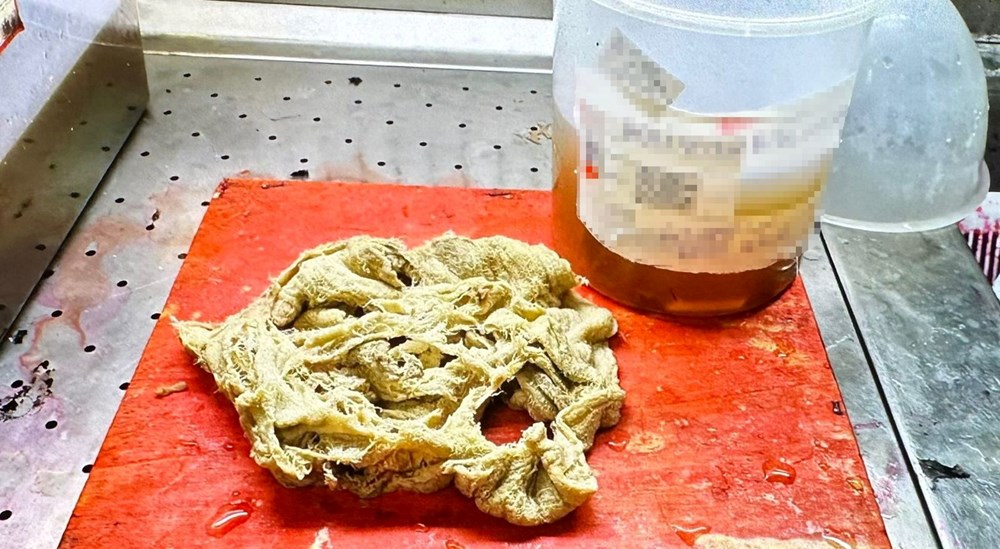 Doğumda unutuldu, iki yıl sonra ortaya çıktı: Gazlı bez ihmaline soruşturma - 7