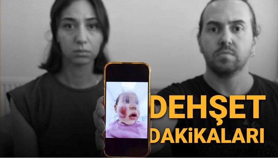 İki yaşındaki bebeğe kreşte dayak: "Yüzü parçalanmıştı, morluk içindeydi"