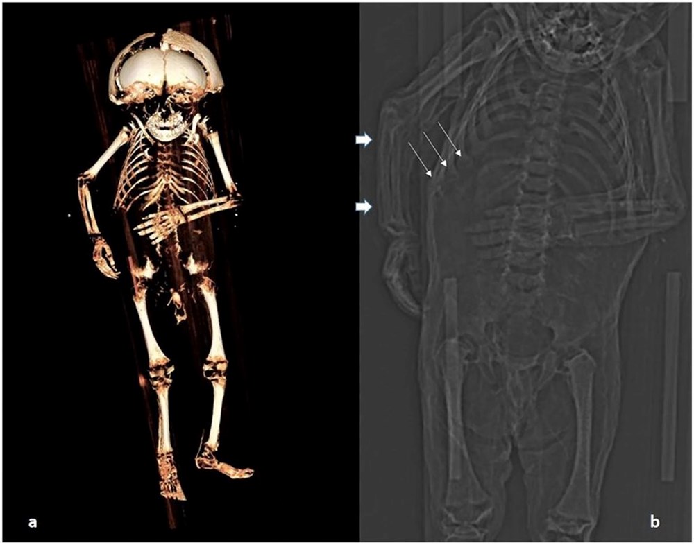 400 yıl önce ölen mumyalanmış bebeğin gizemi çözüldü! - 7