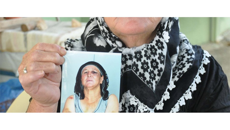 Koca şiddetinin izlerini fotoğrafladı
