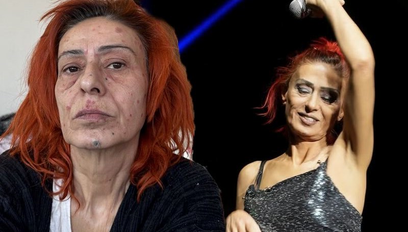 Yıldız Tilbe'nin yüzünde yanıklar meydana geldi: Son halini paylaştı
